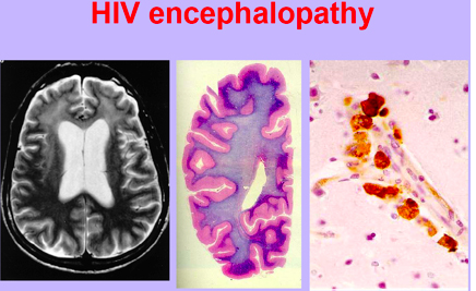 HIV-2.jpg